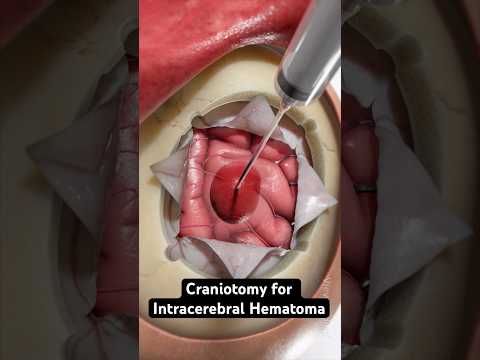 Removing pooled blood from the brain (3D Animation)