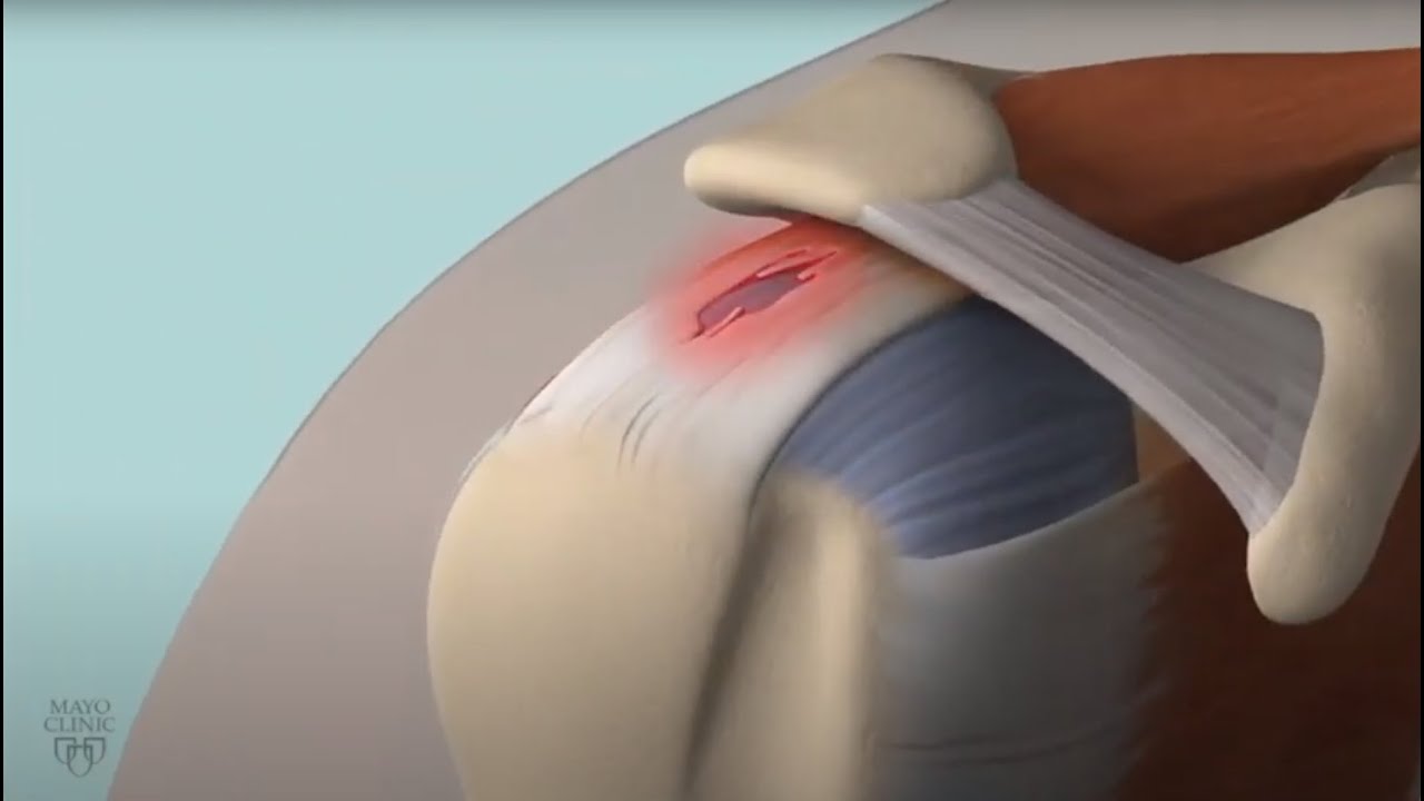 Understanding Rotator Cuff Damage: Causes, Symptoms & Treatment 🩺