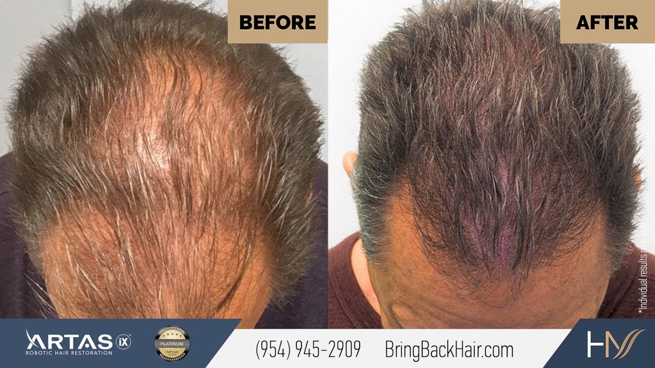 How SMP Works: Hair Restoration with Dr. Max