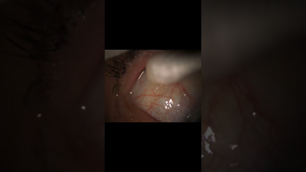 Contact Lenses Gone Wrong: What to Do When Your Lens Moves Out of Place 👁️