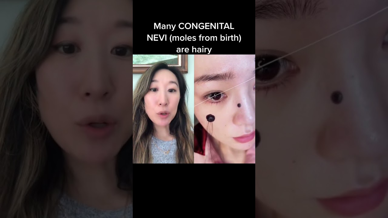 Hair Growth from Moles: Watch for Changes 🧐