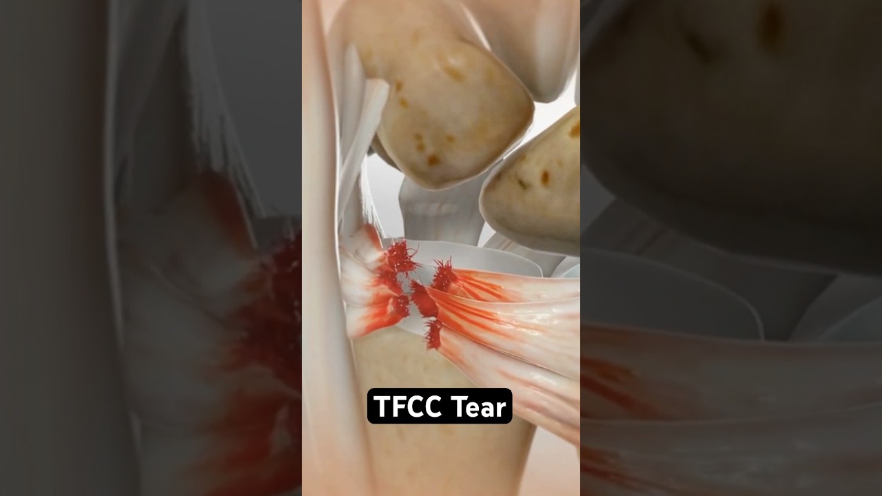 Understanding Wrist Pain: What a TFCC Tear Looks Like in 3D Animation 🖐️