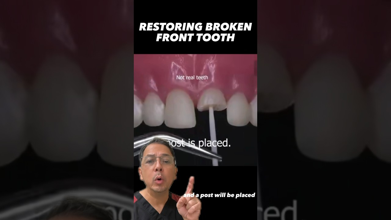 Save Your Front Tooth with Root Canal & Crown 🦷