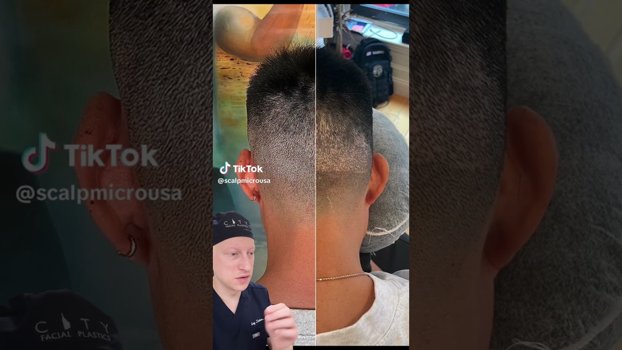 Amazing Scalp Micropigmentation! | Surgeon Reacts