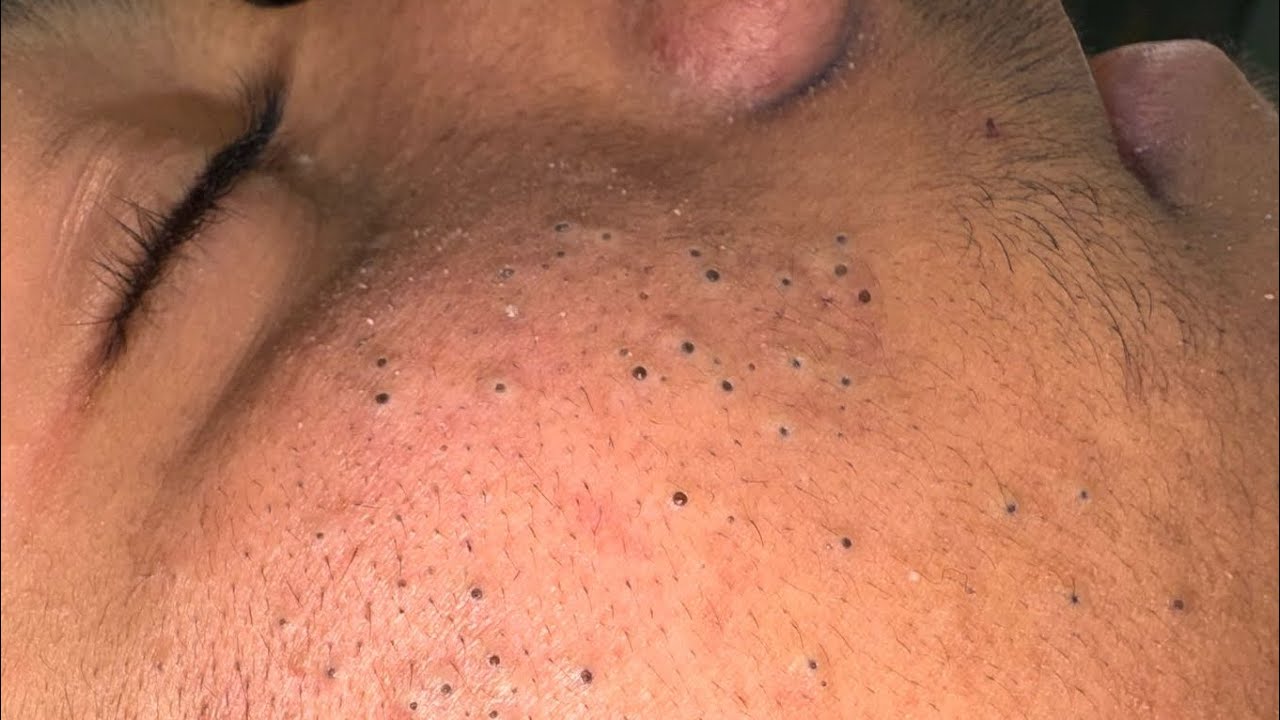Satisfying Blackhead & Pimple Popping | Best Acne Solutions