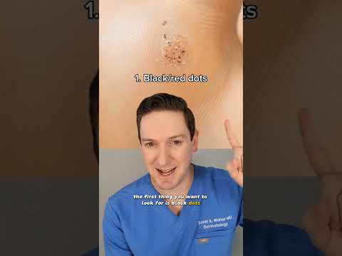 Dermatologist explains how to tell if you have a wart! #wart #verruca #whatsonmyskin #plantarwart