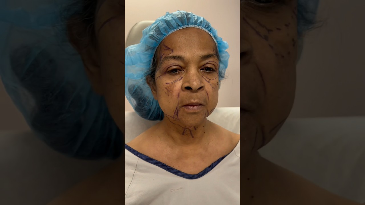 Stunning Facelift Transformation ✨