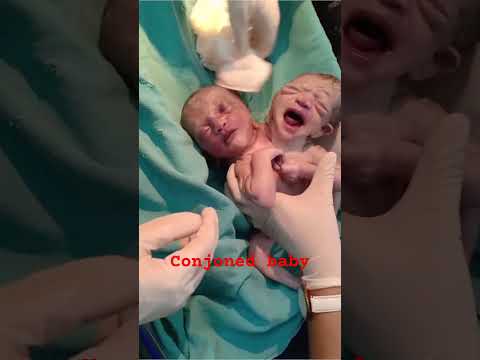 Conjoned twins viral #twinsbaby #twins #conjoinedtwins #conjoint #youtubeshorts #shorts #viralshorts