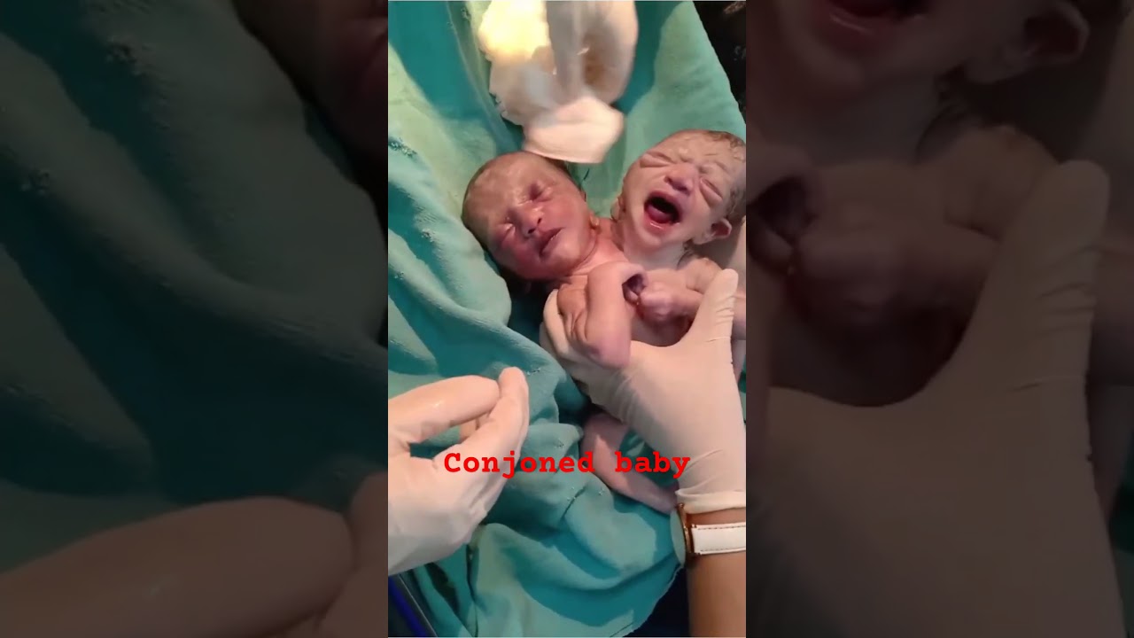 Incredible Viral Video of Conjoined Twins ❤️ | Must-See Moment
