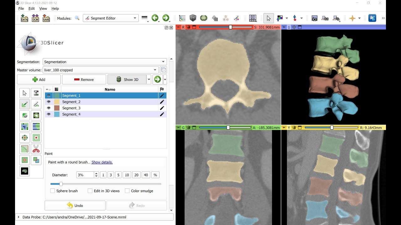 Semi-Auto Vertebra Segmentation in CT 🩻