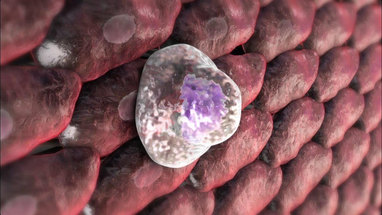 Heart Attack from Atherosclerosis 🫀