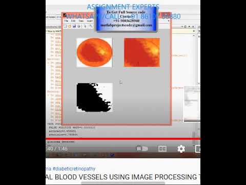 ANALYSIS OF RETINAL BLOOD VESSELS -MATLAB IMAGE PROCESSING TECHNIQUES -MATLAB ASSIGNMENTS PROJECT