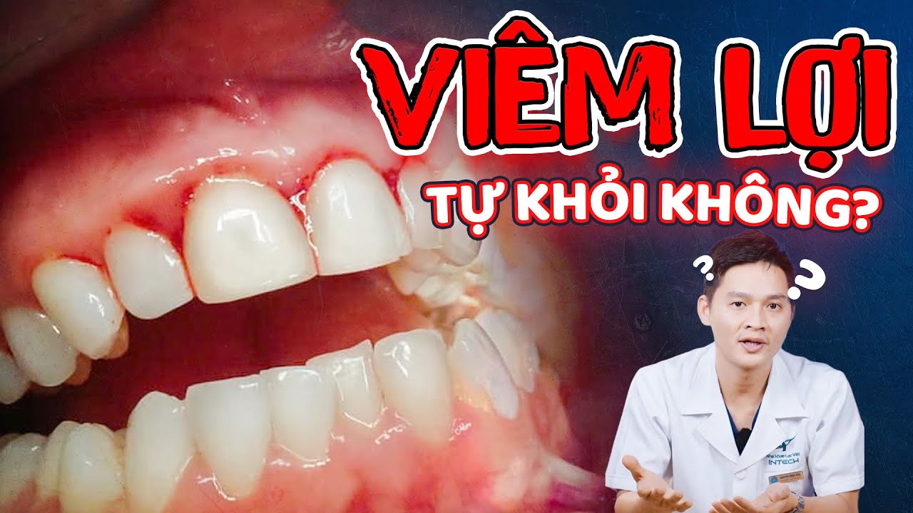 Viêm Lợi Có Tự Khỏi Được Không? Khi Nào Cần Đến Nha Khoa? Cách Chữa Khỏi Viêm Lợi Tại Nhà Hiệu Quả!