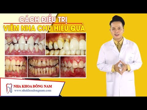 Cách Điều Trị Viêm Nha Chu Hiệu Quả 🦷