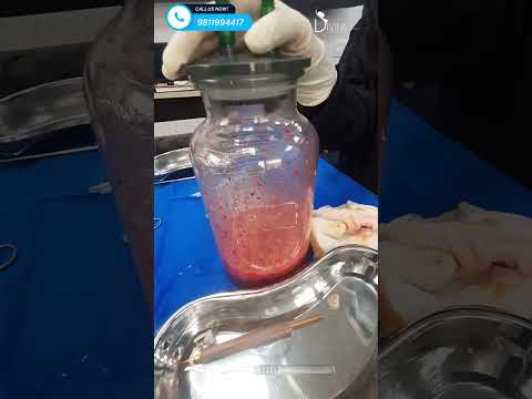 Butt Augmentation Using Fat Grafting and Result | Brazilian Butt Lift in Delhi #shortfeed #shorts