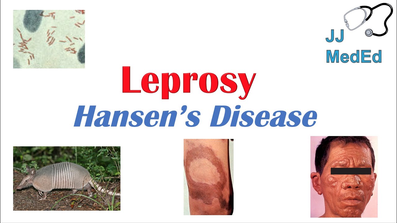 Leprosy (Hansen's Disease): Risks, Signs & Treatment