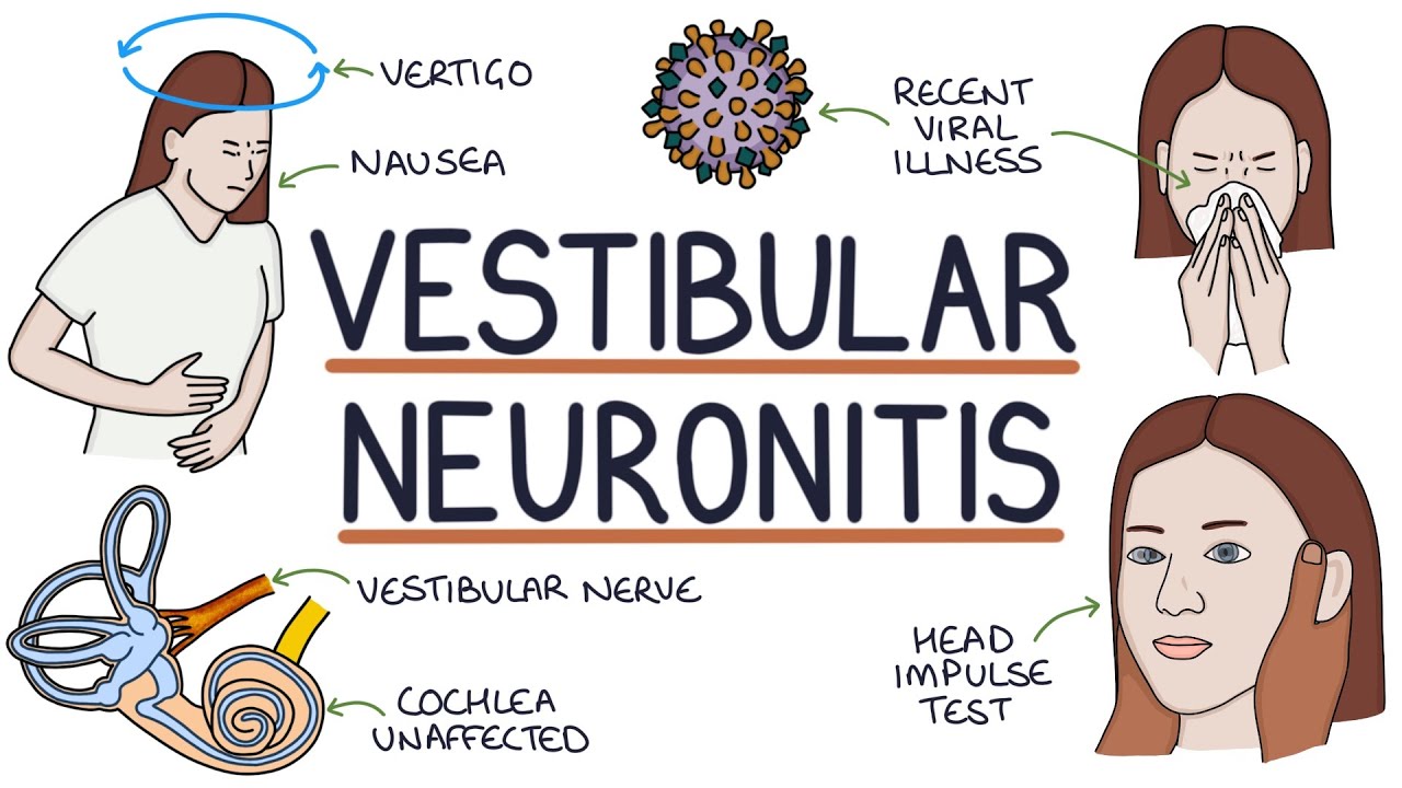 Vestibular Neuronitis Explained 🧠