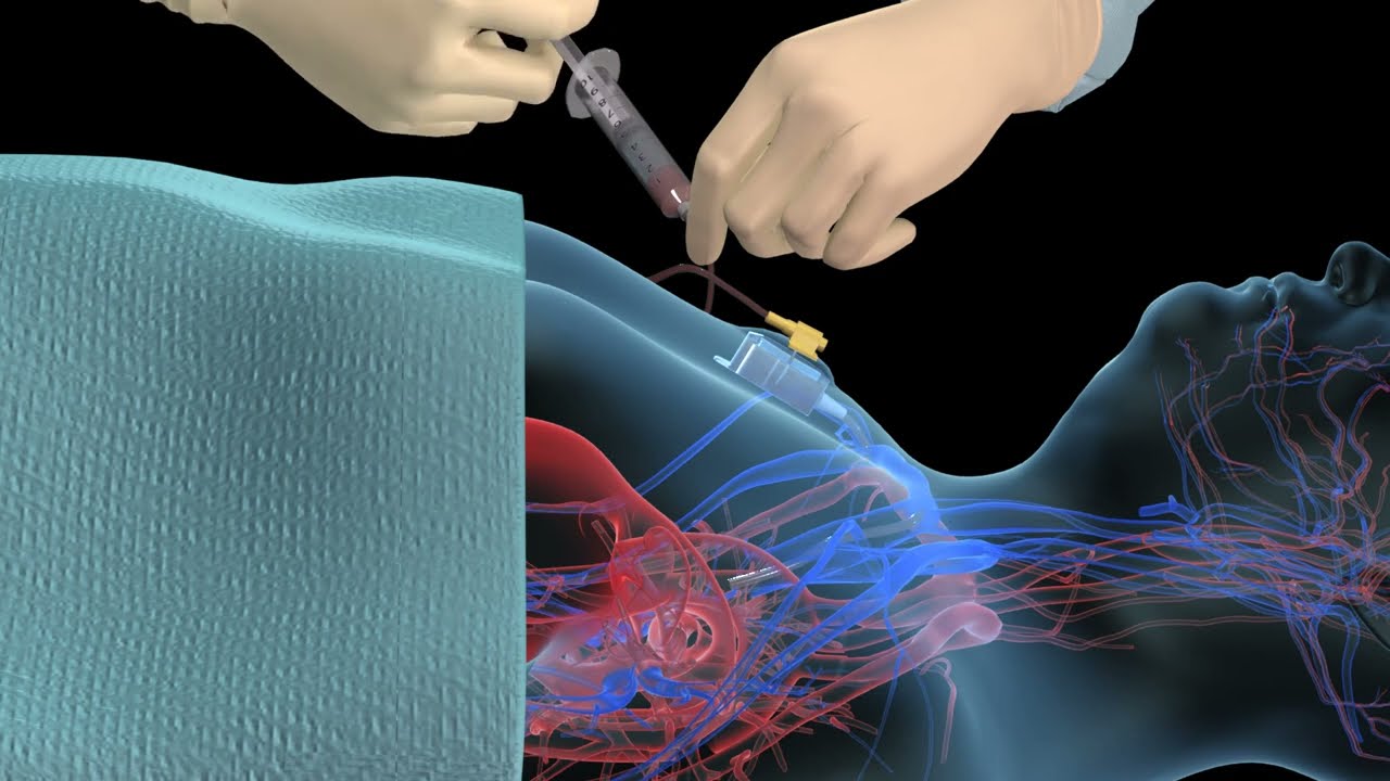 Learn How to Access an Implantable Port with 3D Animation ๐ฉบ