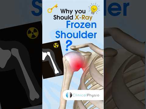 X-Ray Frozen Shoulder? #physicaltherapy #physiotheraphy #frozenshoulder #shoulderpain