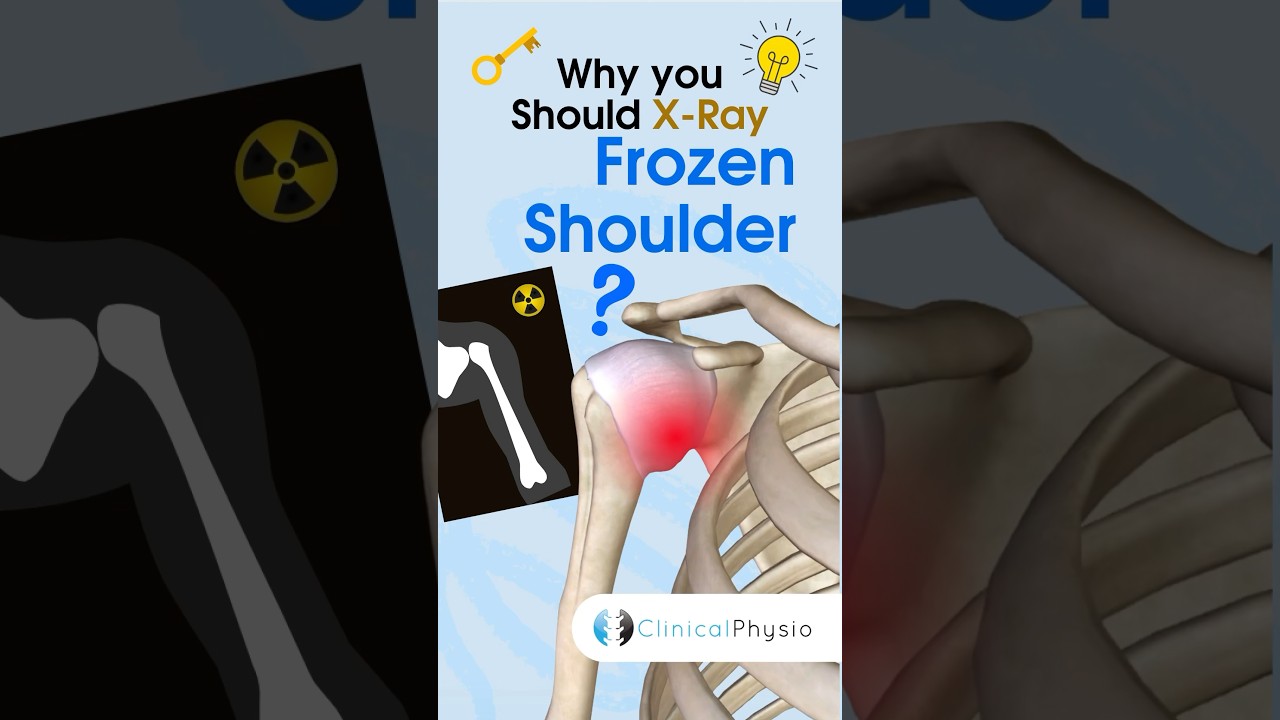 X-Ray Findings in Frozen Shoulder: What You Need to Know
