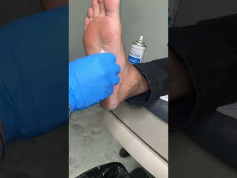 Plantar Fibroma Solution...💉