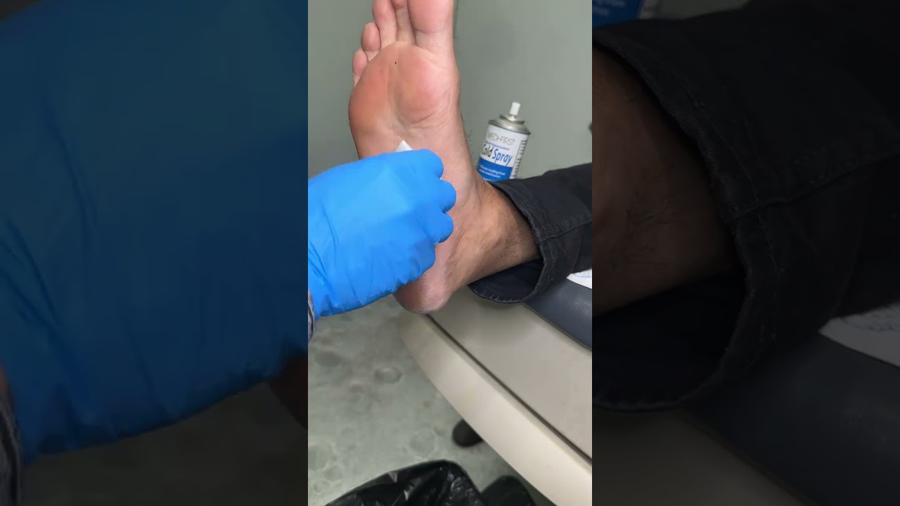 Effective Treatments for Plantar Fibroma 💉 | Podiatrist Tips