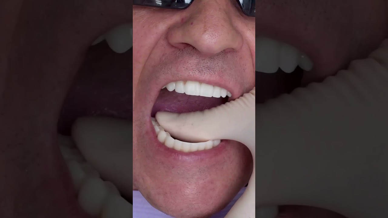 All on 4 Dental Implants in Prague 🇨🇿