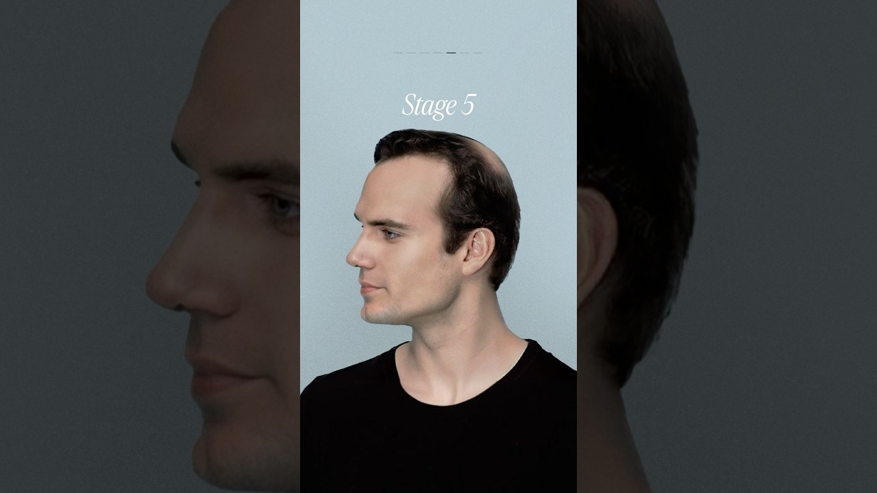 Here’s What Each Hair Loss Stage Looks Like