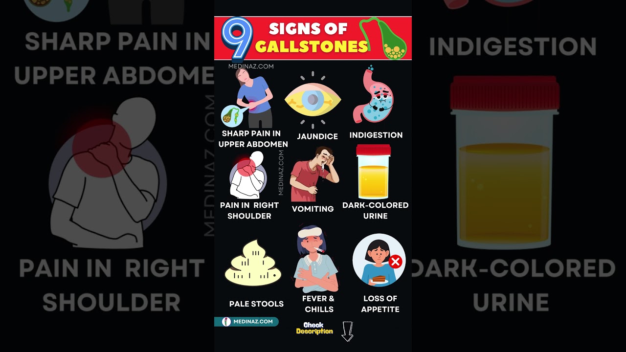 10 Early Signs of Gallstones to Watch For