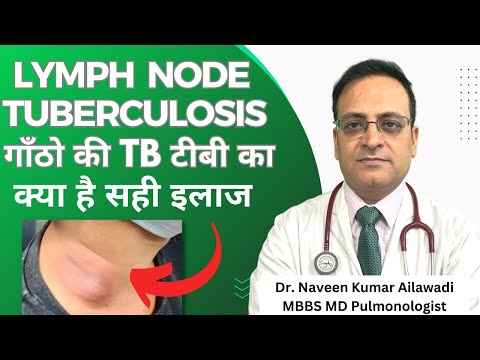 Lymph Node Tuberculosis рдЧрд╛рдБрдареЛ рдХреА TB рдЯреАрдмреА рдХрд╛ рдХреНрдпрд╛ рд╣реИ рд╕рд╣реА рдЗрд▓рд╛рдЬ #drnaveenailawadi #lungdoctor