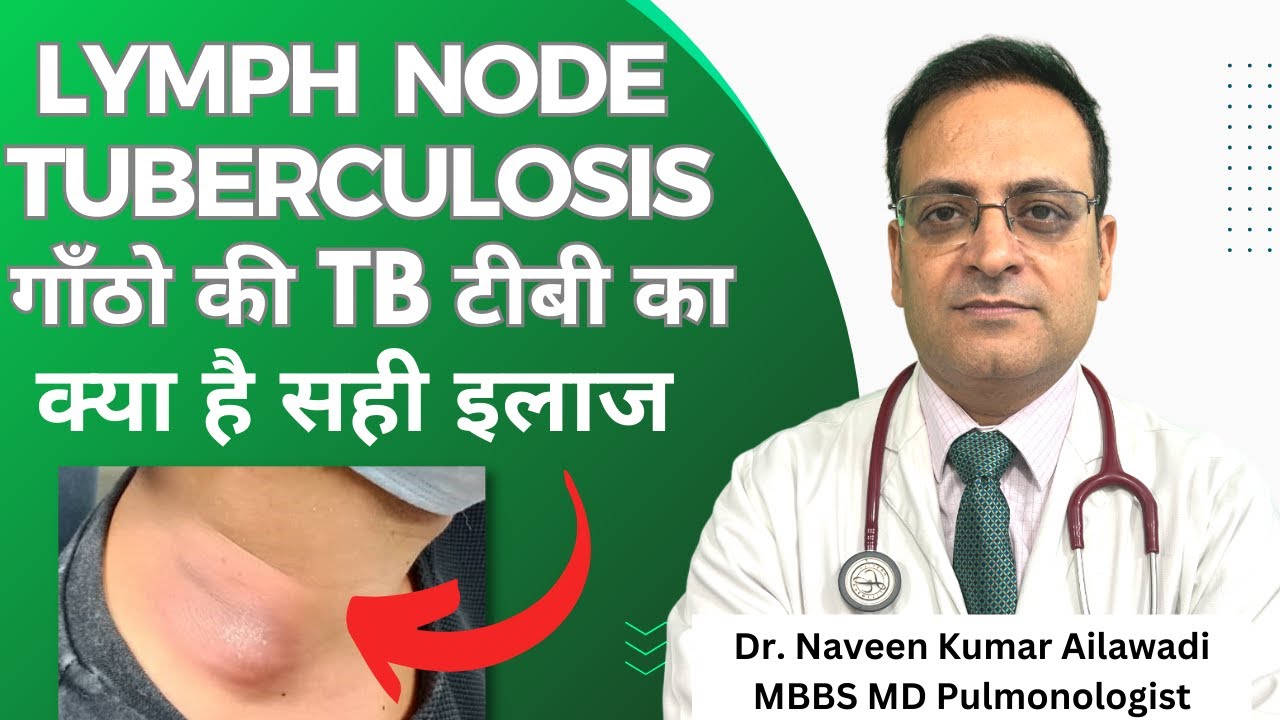 Lymph Node Tuberculosis (TB): Symptoms, Causes & Effective Treatment 🩺