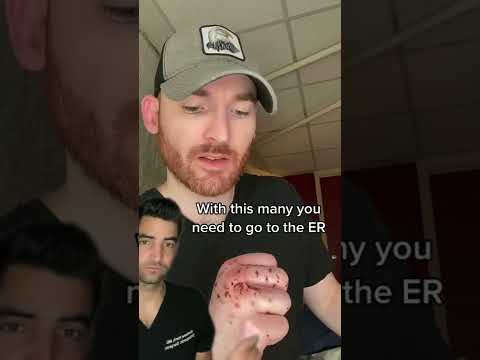 Cat Bite and What to DO