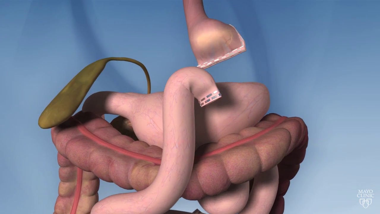 Roux-en-Y Gastric Bypass: Weight Loss Surgery