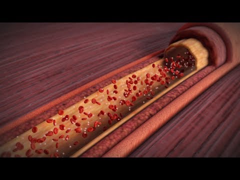 Understanding Heart Attacks | Free Medical Animations