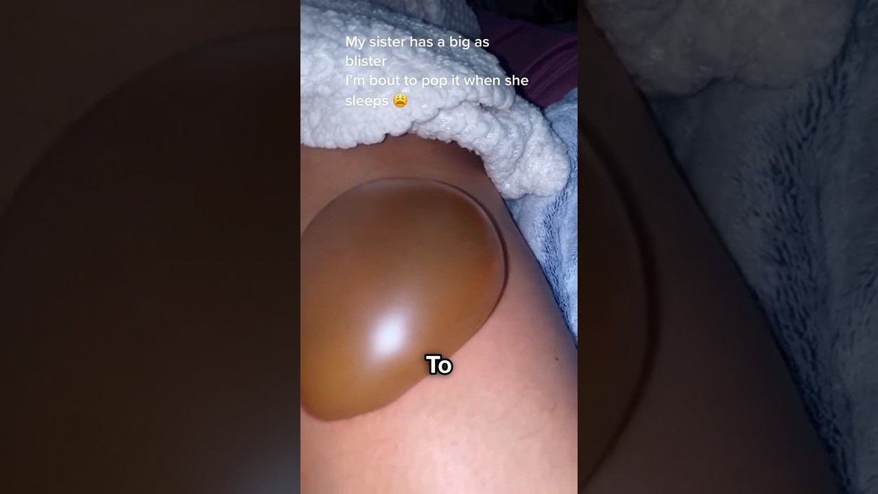 Blister Facts You Need to Know! 😳