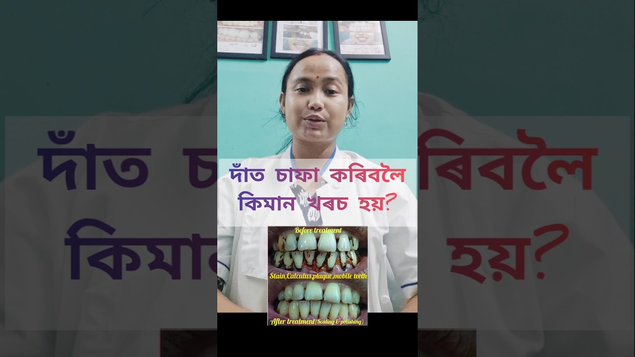 দাঁত চাফা কৰাৰ খৰচ কিমান?🦷