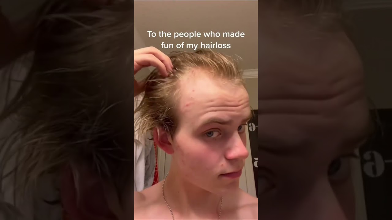 To Those Who Mocked My Hair Loss