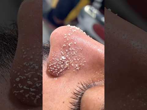 Get Rid Of Blackheads & Whiteheads #blackheads #whiteheads #hack #youtube #diy #video #shorts #viral