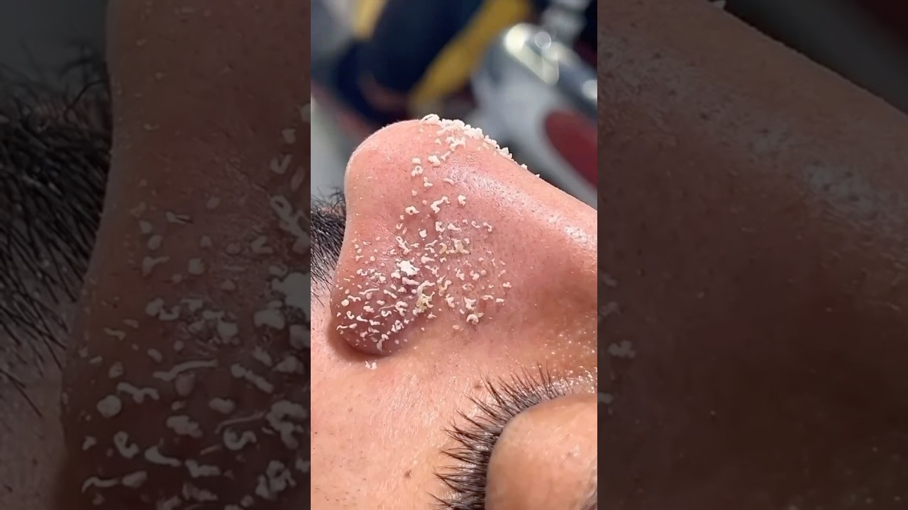 Quick DIY Tips to Remove Blackheads & Whiteheads β¨