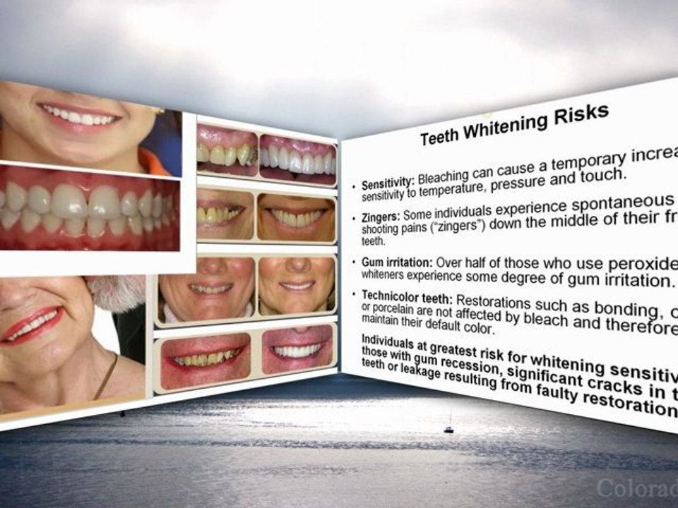 Tooth Discoloration