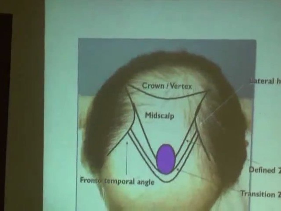 Current Trends in Managing Hair Loss Part 3.wmv