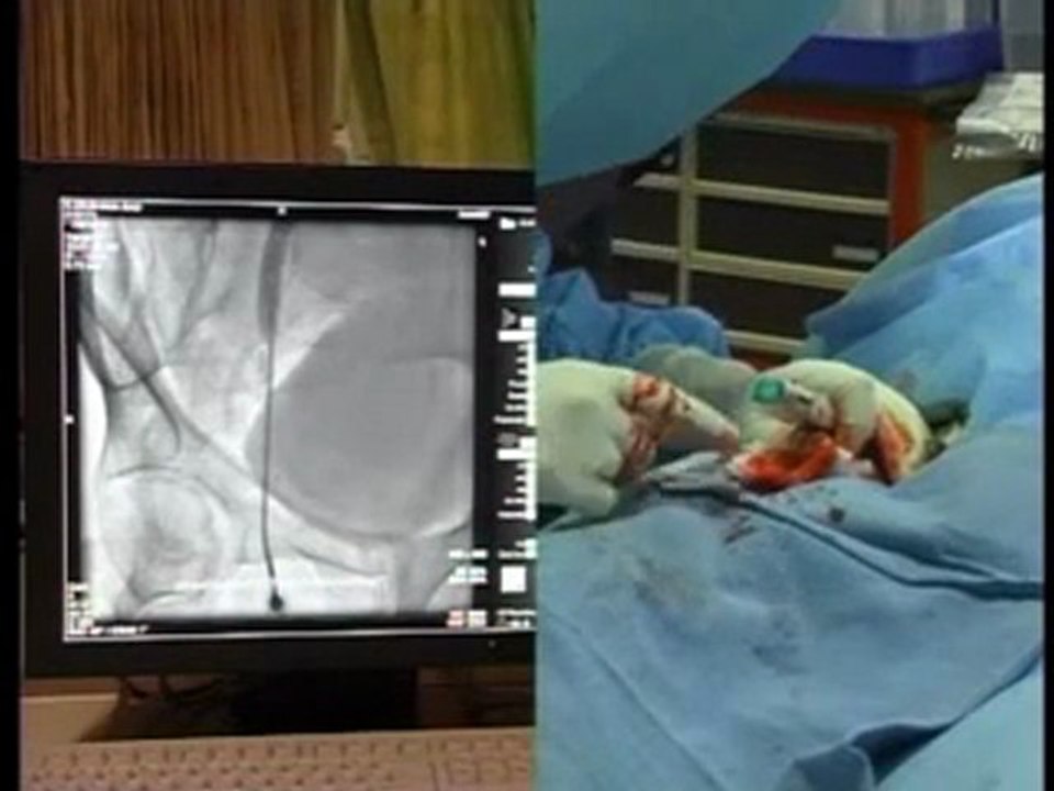 Vascular Access Demonstration - Femoral Access - By Dr.M.Srinivas Rao