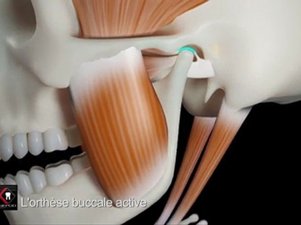 Gouttière dentaire Kiné - Sport (activateur) et la tétine orthodontique active