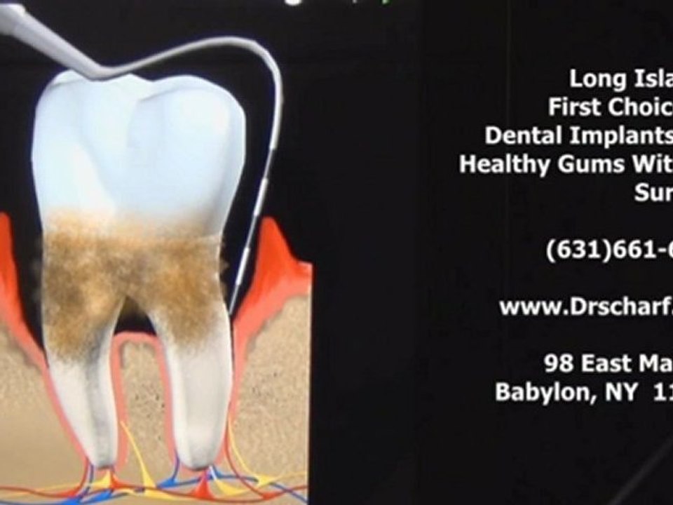 Long Island Periodontist explains gum disease