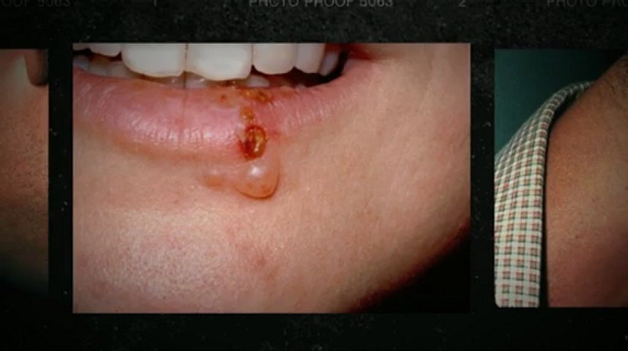 What Is Herpes? Key Facts to Know