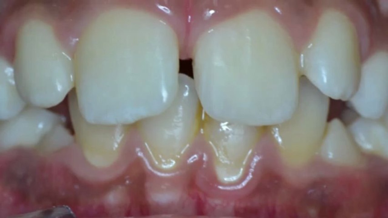 Composite Stratifié