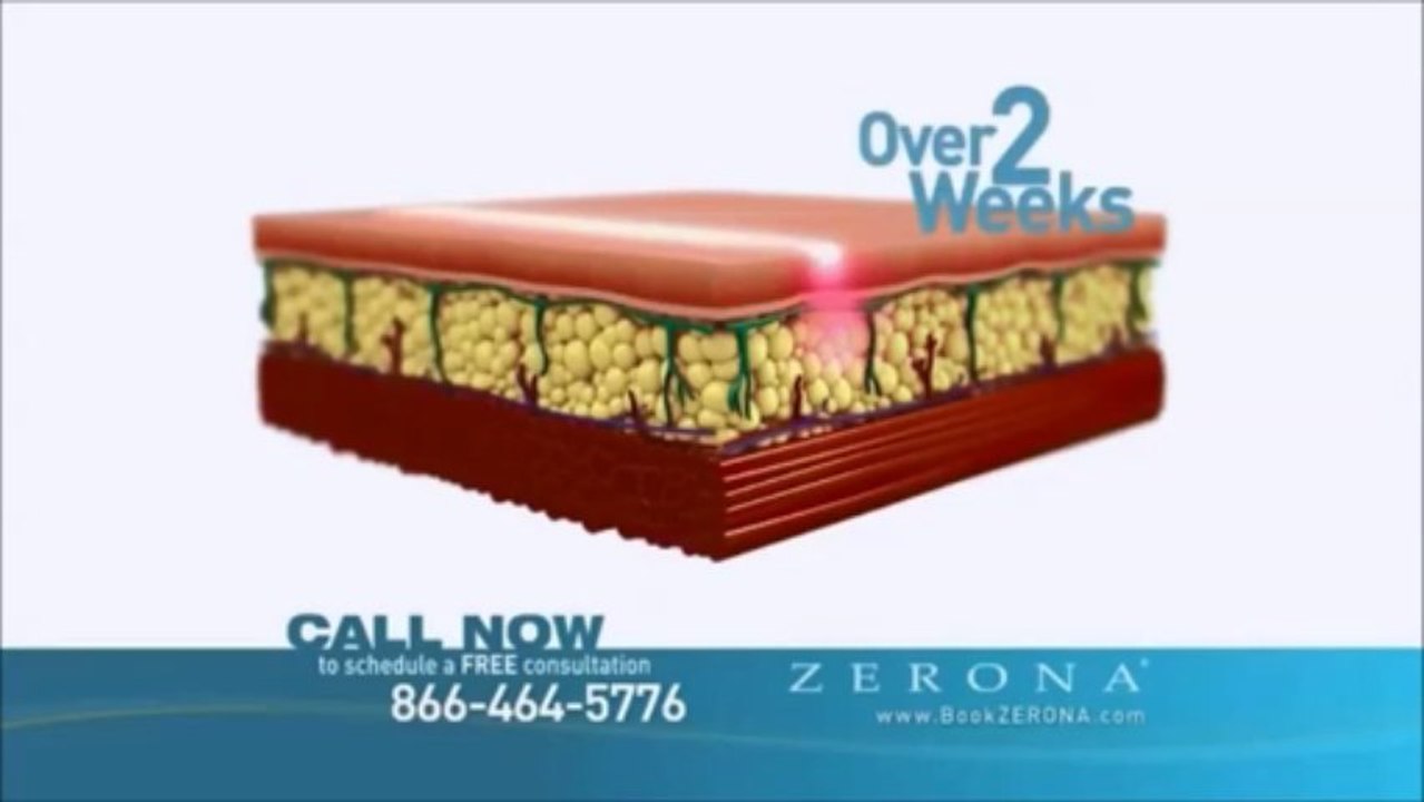 How Zerona Works: Learn More at LipoAdvisor