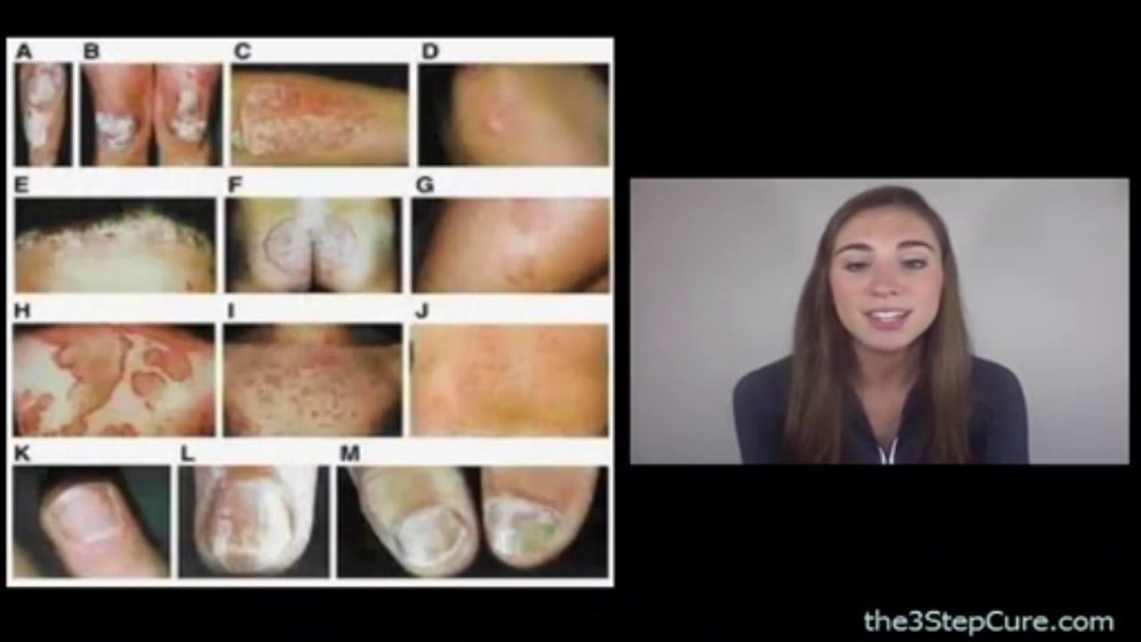 Types of Psoriasis Session 1 - Different Types of Psoriasis Explained