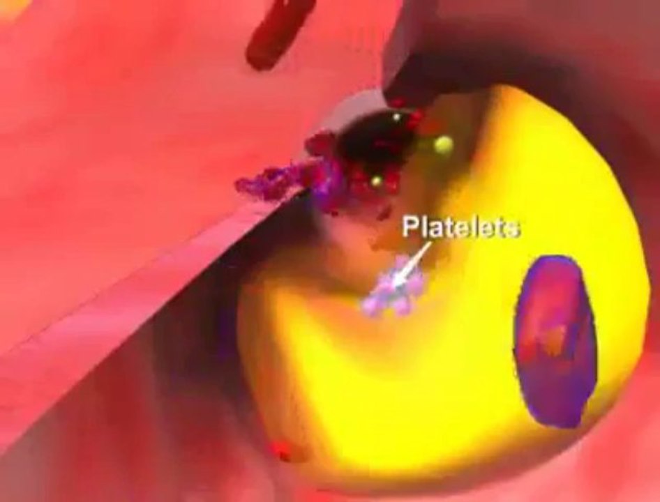 What is HeartAtack and Awareness