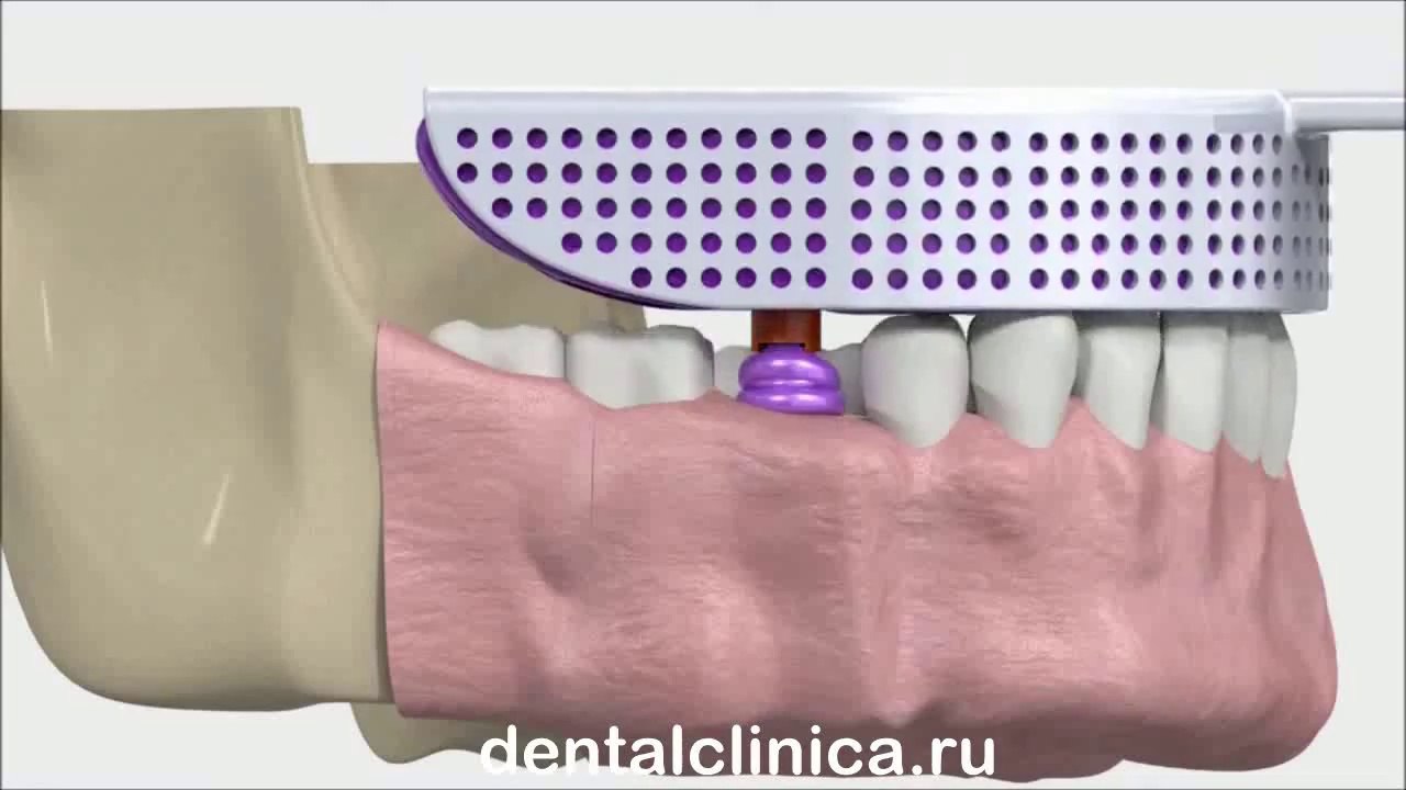 Лечение зубов красивая улыбка коронка циркониевая металлокерамика приятные цены протезирование имплант СГС с абатмантом экспересс терапия